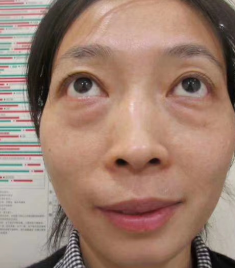 去眼袋手术