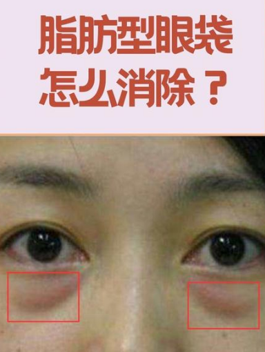 去眼袋手术