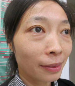 去眼袋手术