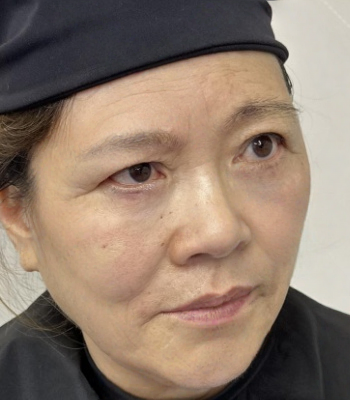 去眼袋手术