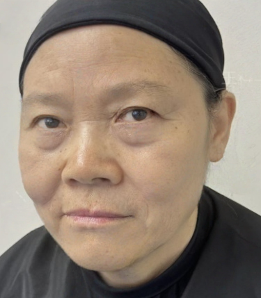 去眼袋手术
