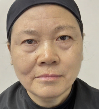 去眼袋手术