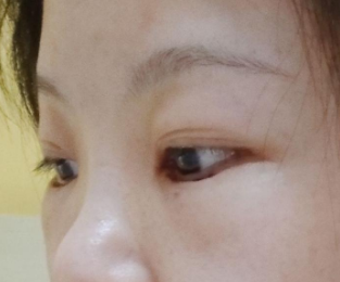去眼袋手术