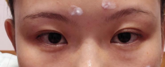 去眼袋手术