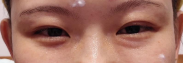 去眼袋手术