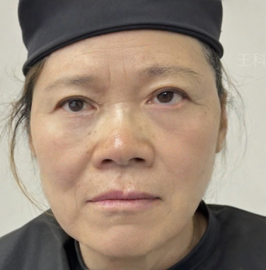 去眼袋手术