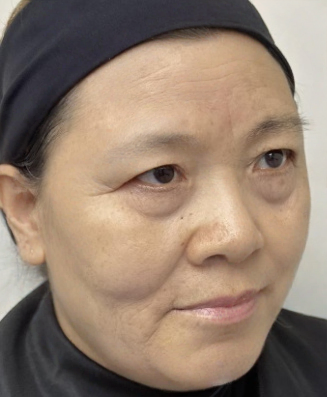 去眼袋手术