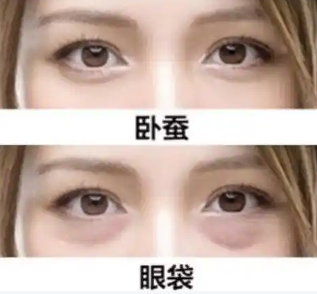 去眼袋手术