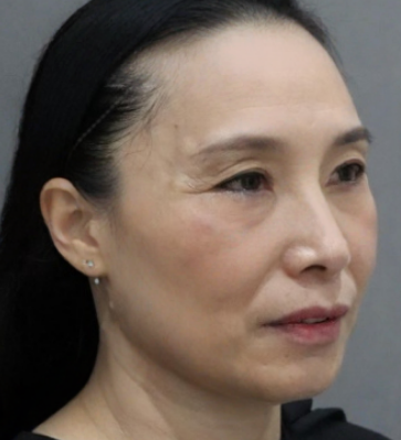 去眼袋手术