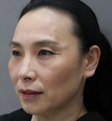 去眼袋手术