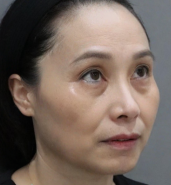 去眼袋手术
