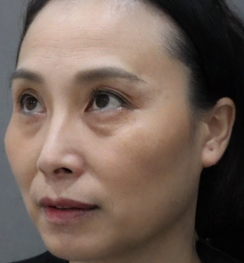 去眼袋手术