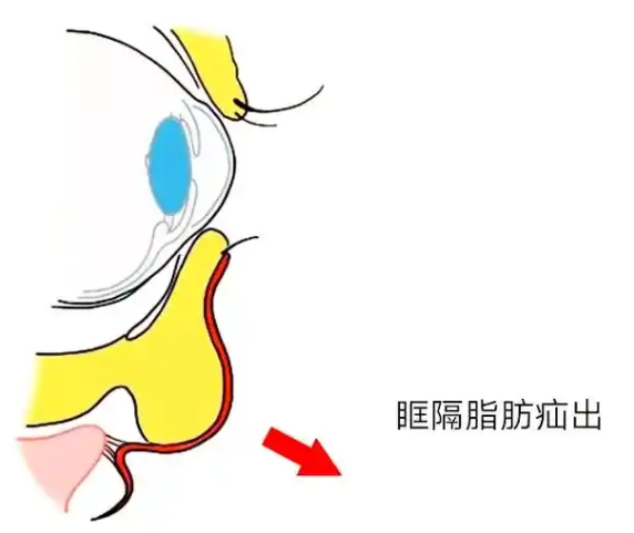 去眼袋手术