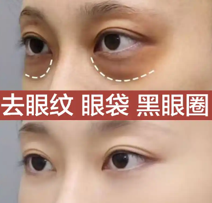 眼袋