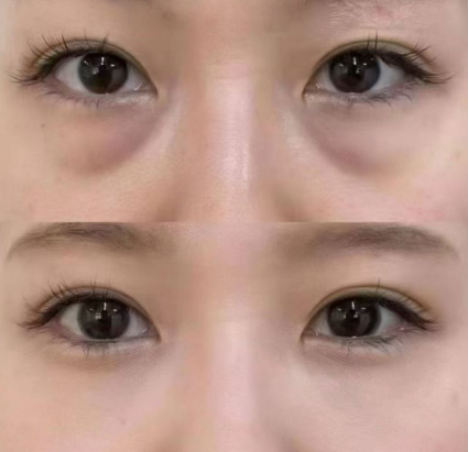 眼袋