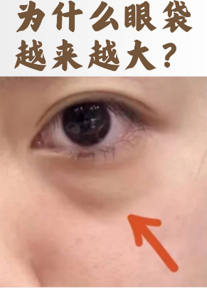 眼袋