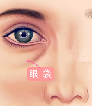 眼袋