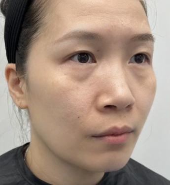 去眼袋手术