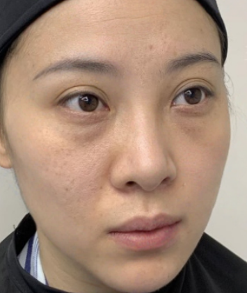 去眼袋手术