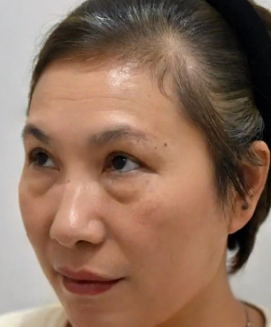 去眼袋手术