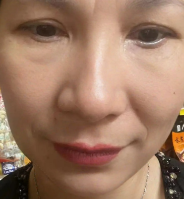 去眼袋手术