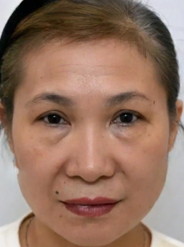 去眼袋手术