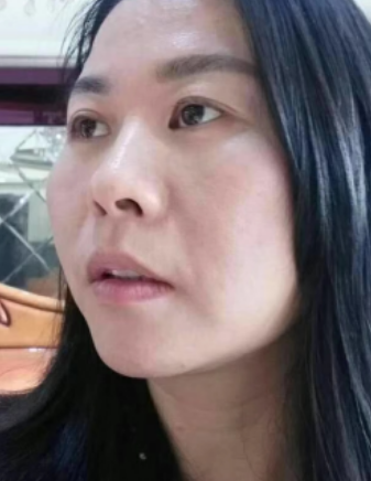 去眼袋手术