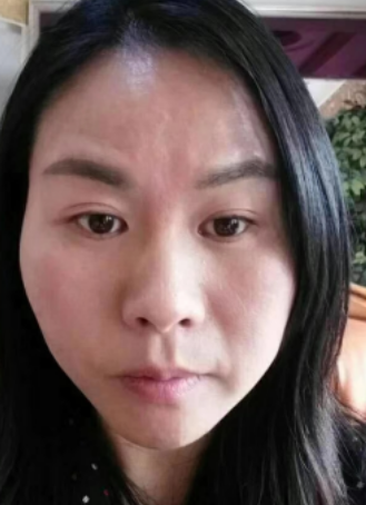 去眼袋手术