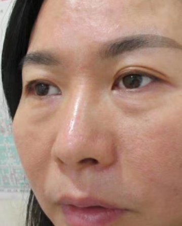 去眼袋手术