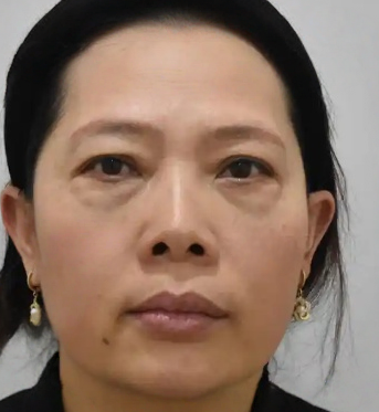 去眼袋手术