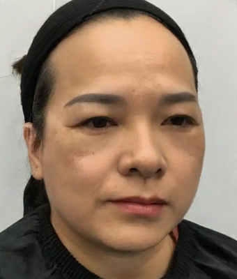 去眼袋手术