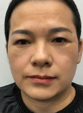 去眼袋手术