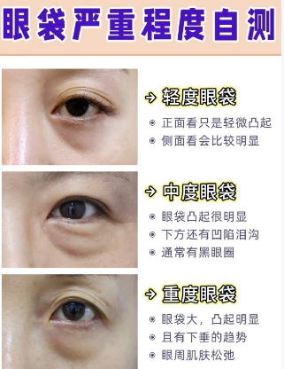 眼袋