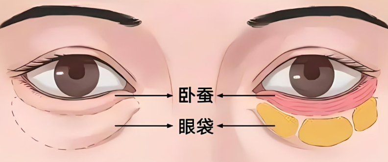 眼袋