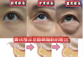 眼袋