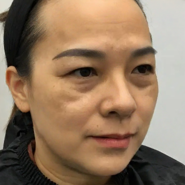 去眼袋手术