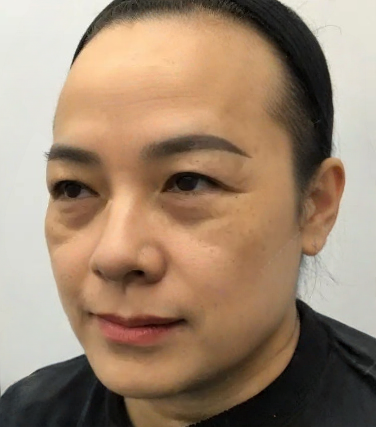 去眼袋手术