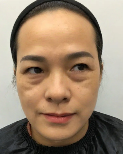 去眼袋手术