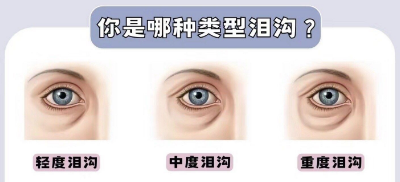 泪沟