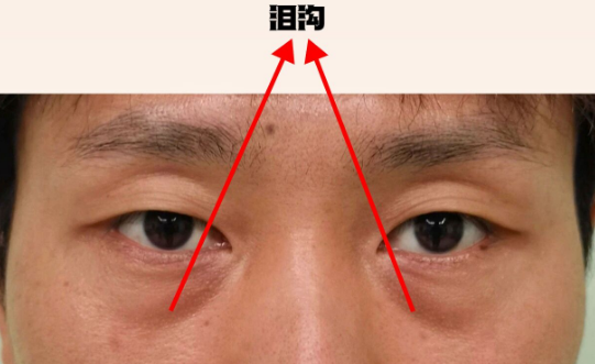 泪沟