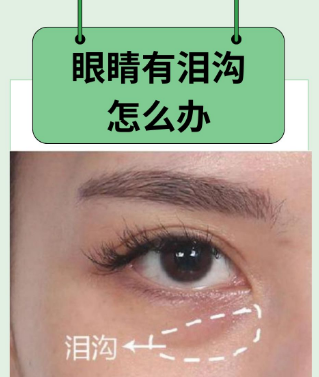 泪沟