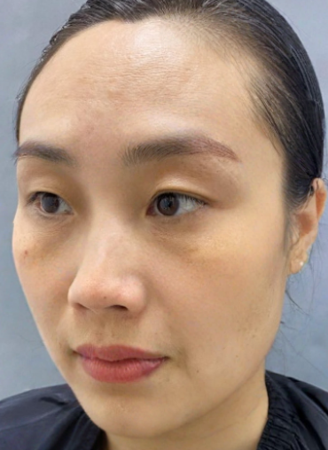 去眼袋手术