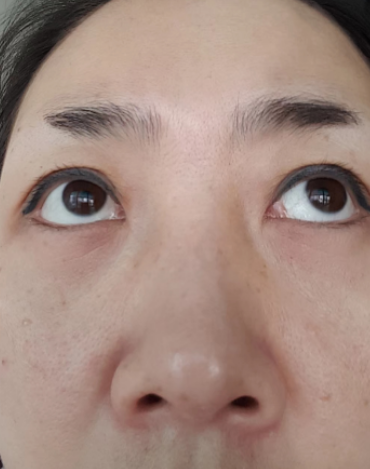 去眼袋手术