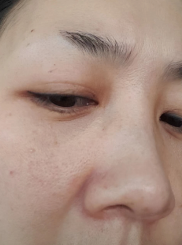 去眼袋手术