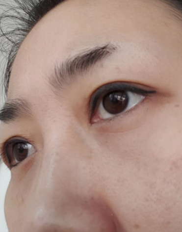 去眼袋手术