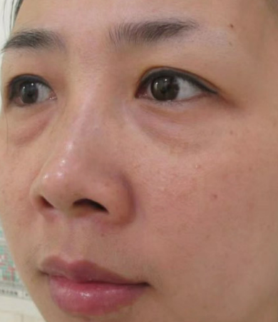 去眼袋手术