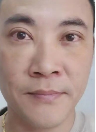 去眼袋手术