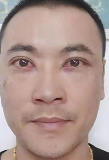 去眼袋手术
