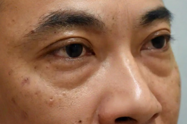 去眼袋手术