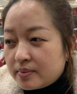 去眼袋手术